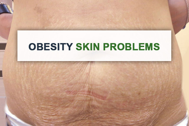 You are currently viewing Obesity Skin Problems